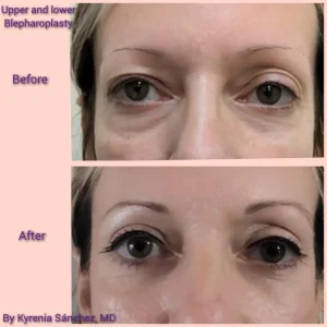 kysa-cosmetic-clinic-blepharoplasty-font-09WhatsApp Image 2026-05-02 at 2.08.18 PM (3)