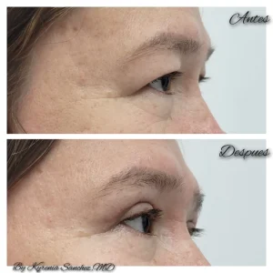 kysa-cosmetic-clinic-blepharoplasty-right-05