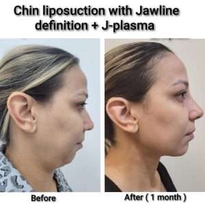 Chin and Neck Liposuction Pricing in Cape Coral