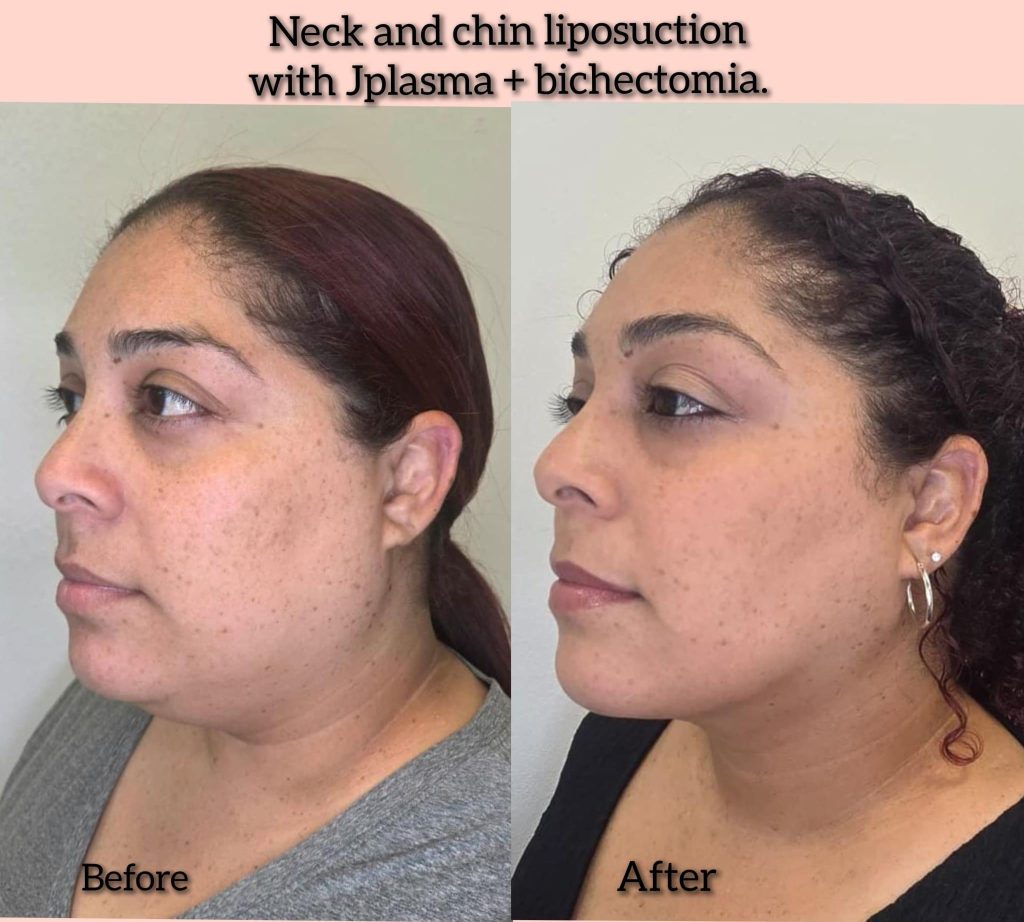 Chin and Neck Liposuction in Cape Coral, FL