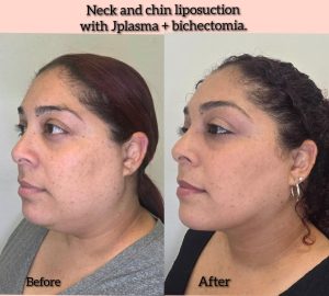 Chin and Neck Liposuction in Cape Coral, FL