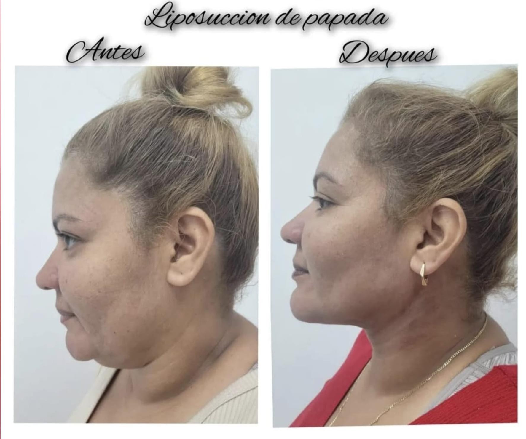 What Chin and neck liposuction Procedure Targets