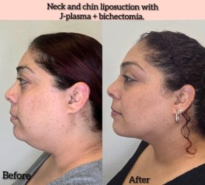 When Chin and Neck Liposuction May Make Sense
