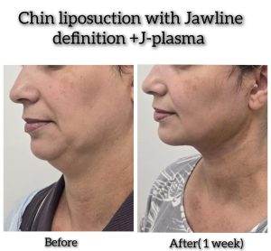 Why Patients Choose KYSA Cosmetic Clinic for Chin and Neck Liposuction in Cape Coral