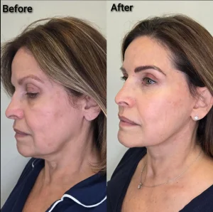 Side-by-side comparison of deep plane face and neck lift transformation at Kysa Cosmetic Aesthetic Clinic in Cape Coral.