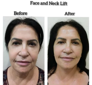 Before and after results of a comprehensive face and neck lift surgery at Kysa Cosmetic Aesthetic Clinic in Cape Coral.