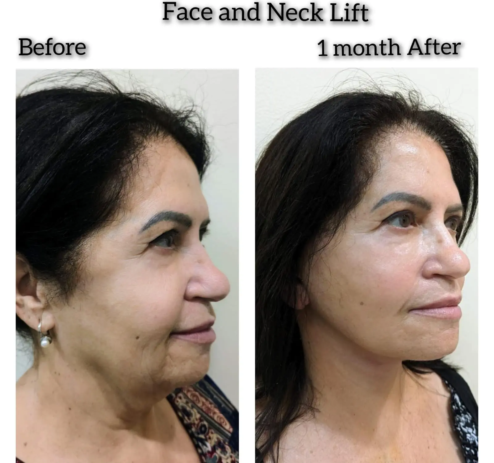 Deep plane facial rejuvenation results highlighting a smooth neck profile and eliminated jowls.