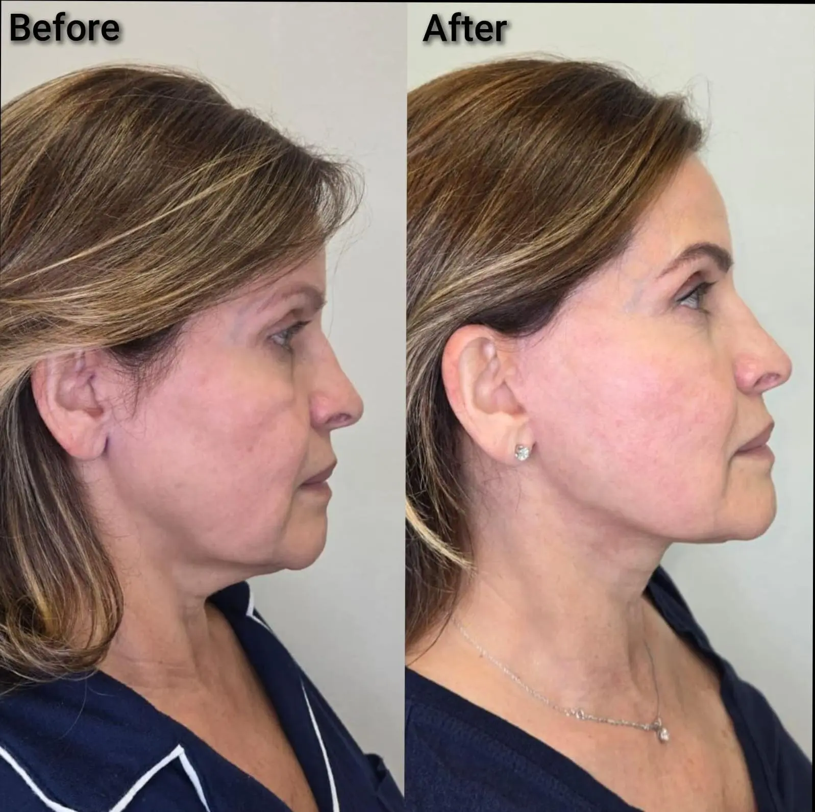 Profile view of a patient showing deep plane face and neck lift structural improvement at Cape Coral cosmetic clinic.