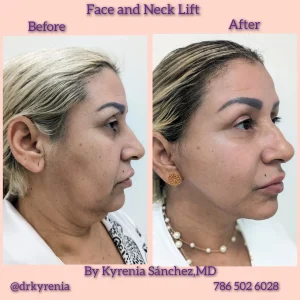 Before and after results of a comprehensive face and neck lift surgery at Kysa Cosmetic Aesthetic Clinic in Cape Coral.