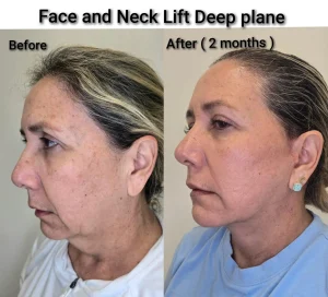 Surgical before and after photos showing submental fat reduction and jawline definition via a deep plane neck lift.
