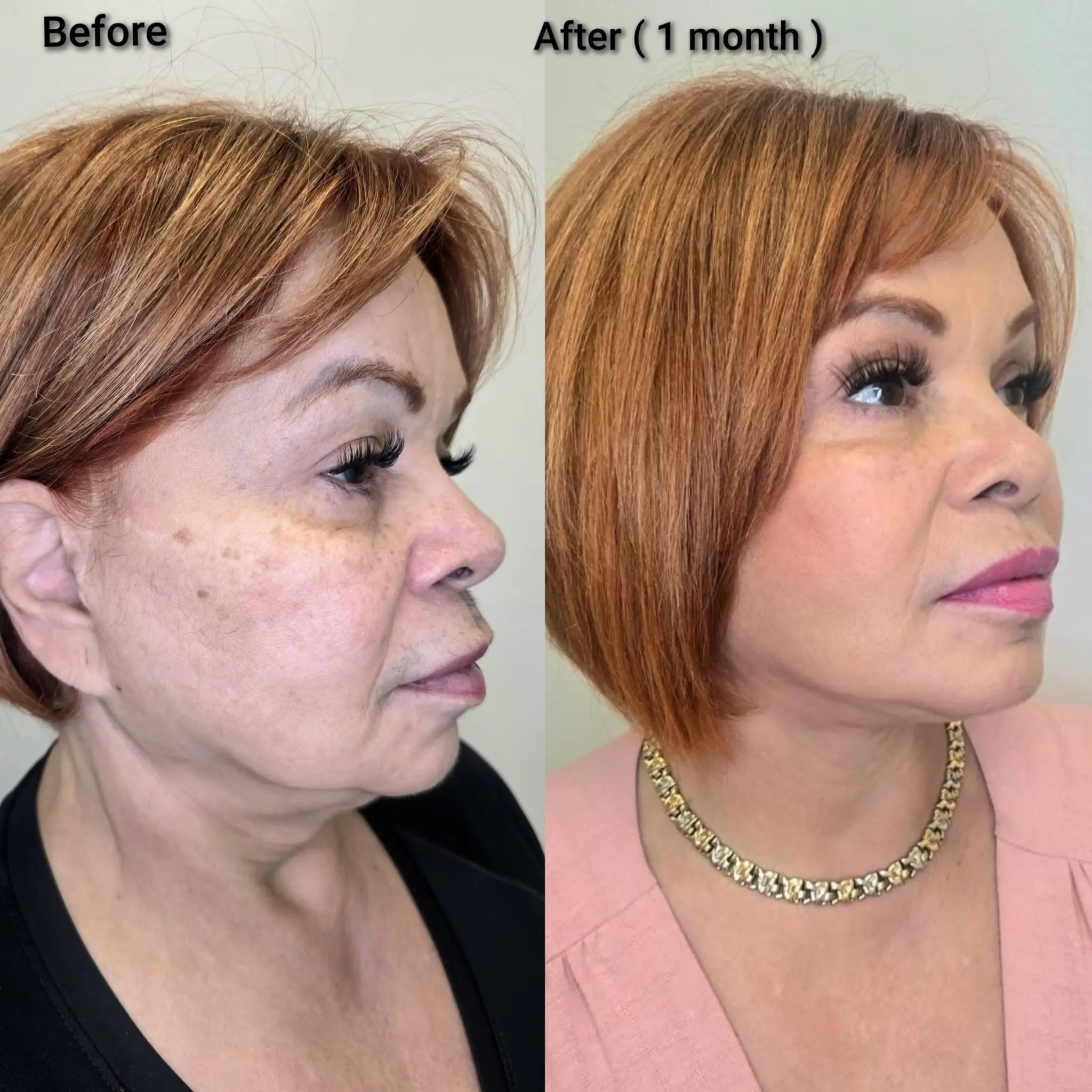 Face and neck lift clinical outcomes achieved by Dr. Kyrenia at Kysa Cosmetic Aesthetic Clinic.