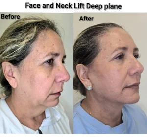 Visible reduction in neck laxity and double chin appearance shown in deep plane face and neck lift before after images.