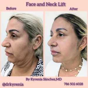 Side view before and after comparisons of saggy neck skin removal and localized submental liposuction.