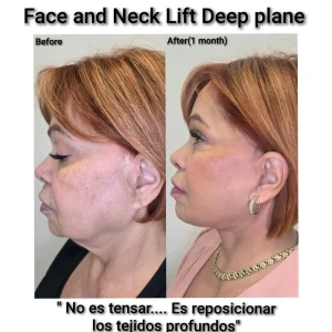 efore and after lower face and neck contouring surgery performed by Dr. Kyrenia.