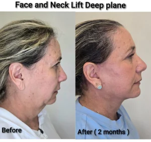 Jawline tightening and submental rejuvenation results following deep plane lower rhytidectomy surgery.