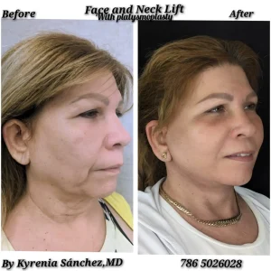 Healing progress 1 month after a face and neck lift, displaying a highly defined chin profile and reduced swelling.