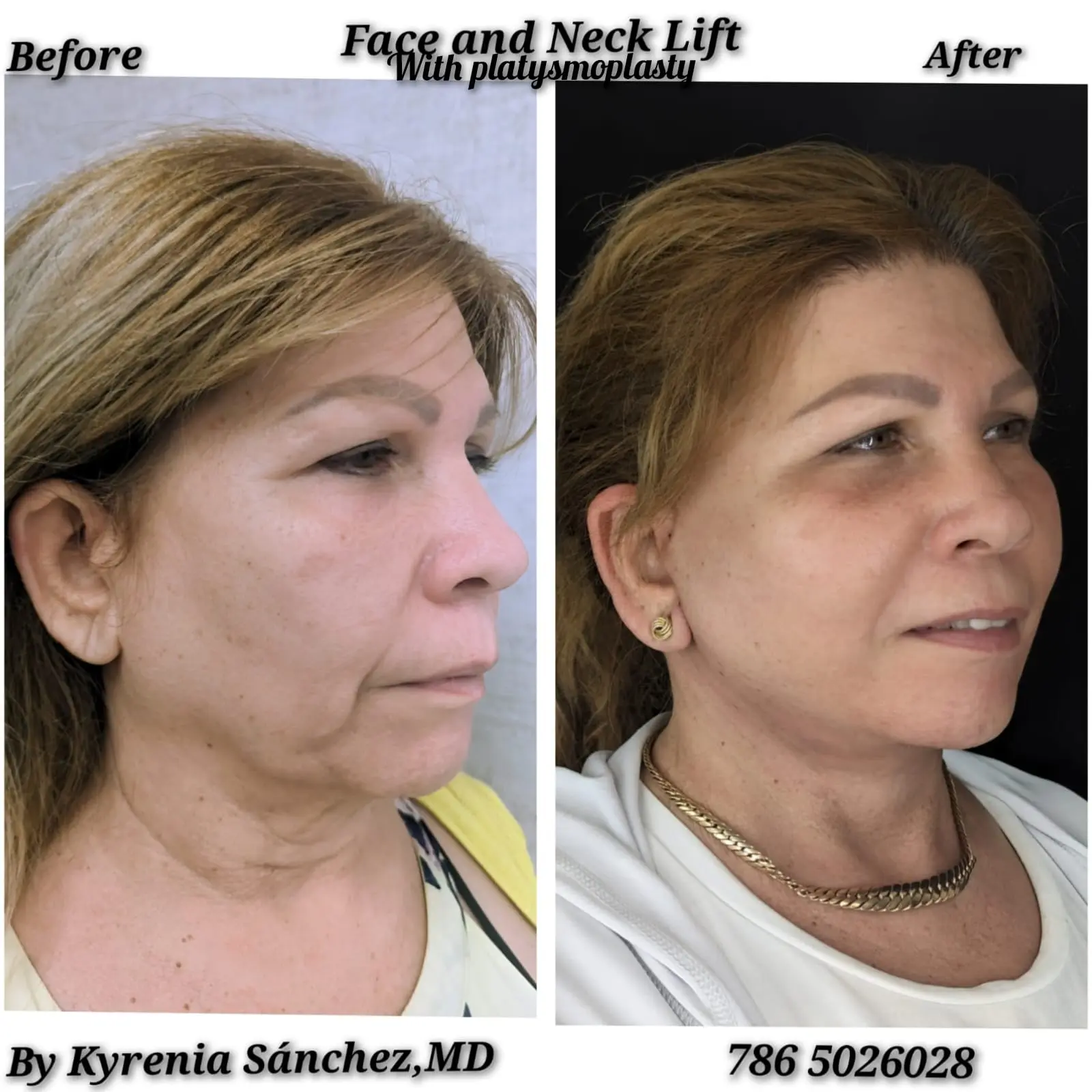 Healing progress 1 month after a face and neck lift, displaying a highly defined chin profile and reduced swelling.