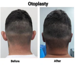 kysa-cosmetic-aesthetic-clinic-adult--back-before-after-otoplasty