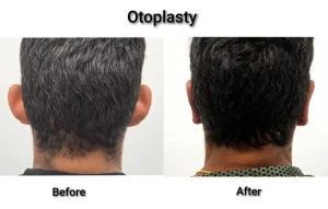 kysa-cosmetic-aesthetic-clinic-adult-before-after-otoplasty