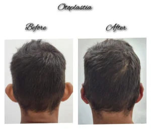 kysa-cosmetic-aesthetic-clinic-adult-before-after-otoplasty-coral-cape