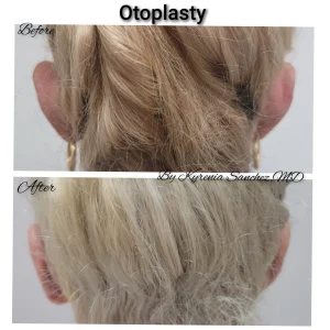 kysa-cosmetic-aesthetic-clinic-adult-woman-back-before-after-otoplasty