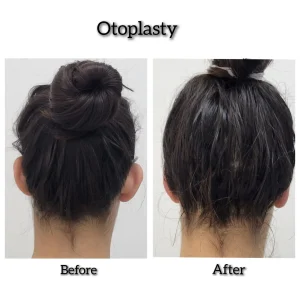 kysa-cosmetic-aesthetic-clinic-adult-woman-before-after-otoplasty