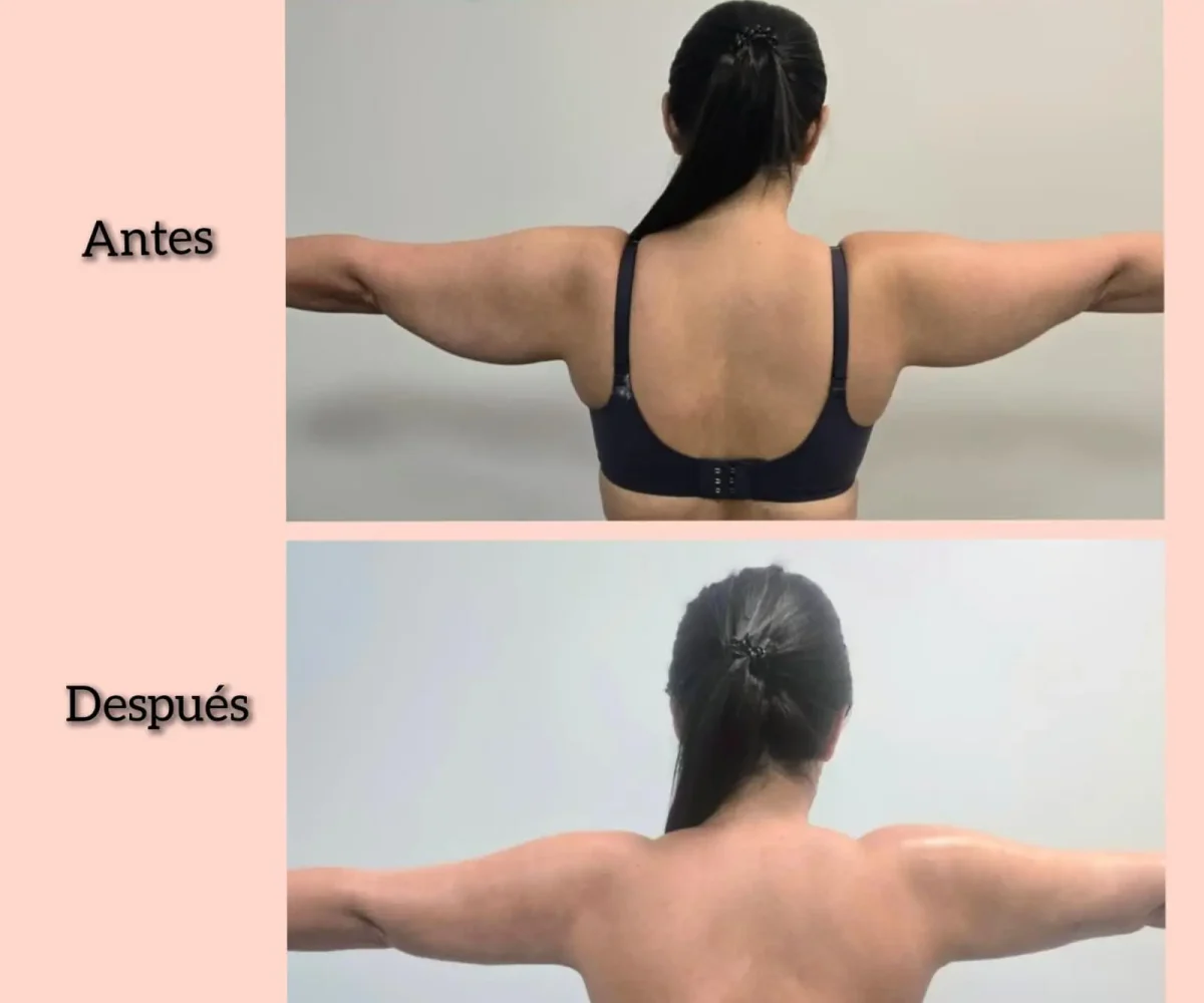 kysa-cosmetic-aesthetic-clinic-arm-lipo-with-j-plasma-before-after
