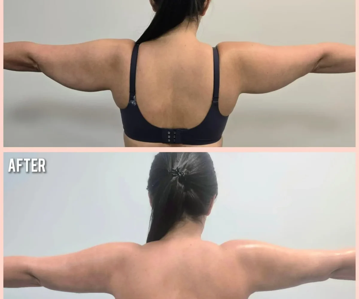 kysa-cosmetic-aesthetic-clinic-arm-liposuction-with-j-plasma-before-after