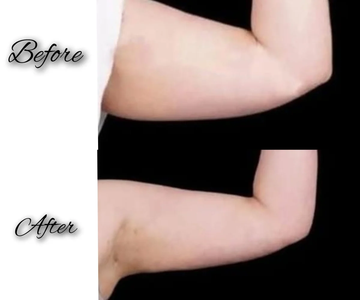 kysa-cosmetic-aesthetic-clinic-one-arm-lipo-with-j-plasma-before-after